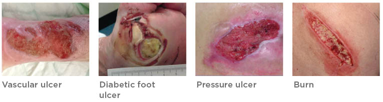 Types of ulcer